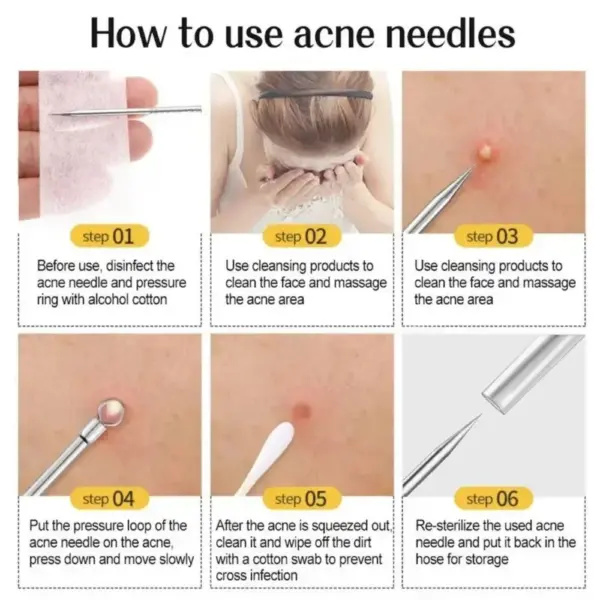 11Pcs Blackhead Removal Tool Kit - Image 5