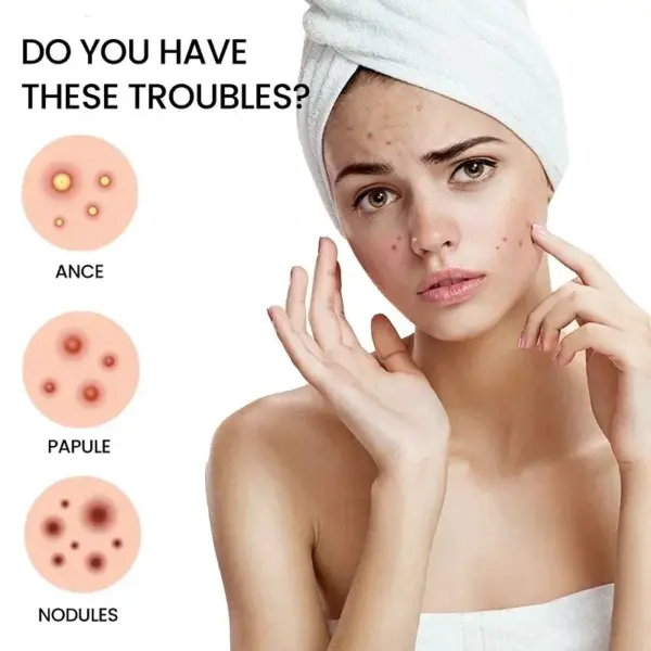 200pcs Acne Repair Patches for Clear Skin - Image 6