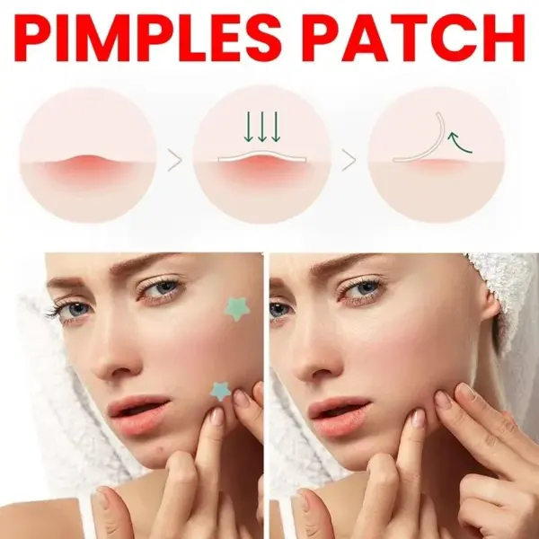 200pcs Acne Repair Patches for Clear Skin - Image 3