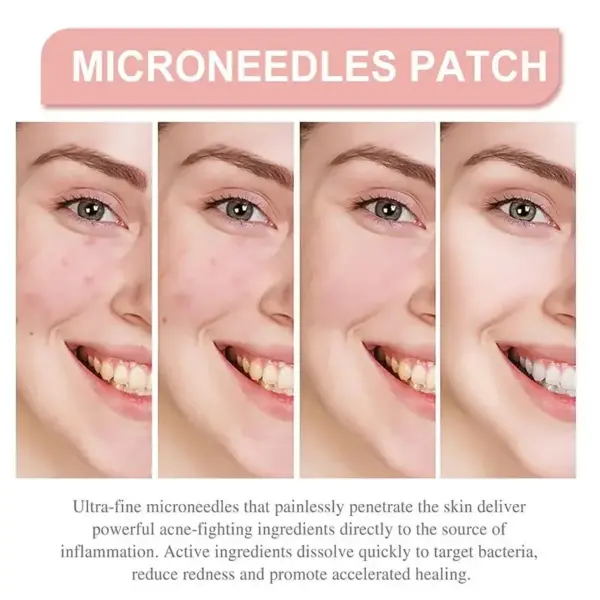 72pcs Invisible Acne Patch for Flawless Skin - Image 4