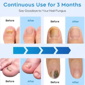 KTS Semi-arc Nail Fungus Laser Device 10 S26ac8efefb3144adad79ebc4d226a375a