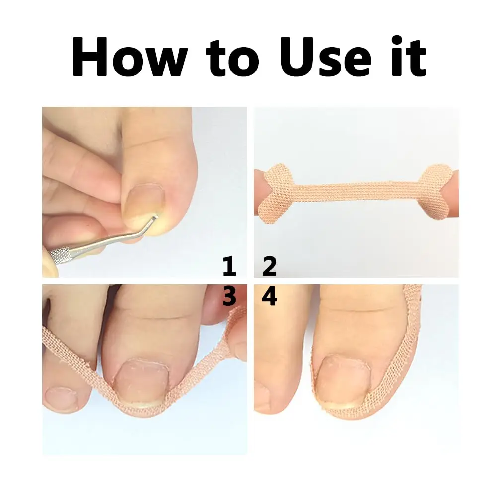 Foot Care Set with Nail Correction Patches 5 Foot Care Set with Nail Correction Patches - Image 5