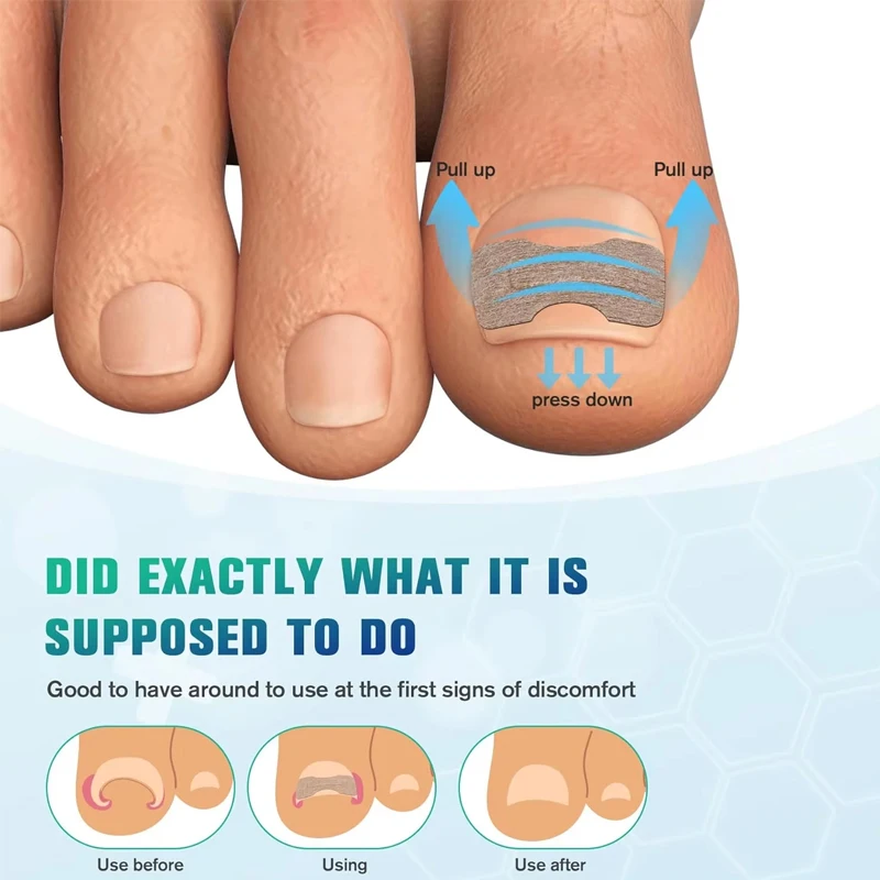 Foot Care Set with Nail Correction Patches 3 Foot Care Set with Nail Correction Patches - Image 3